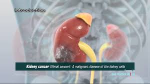 The signs and symptoms of kidney cancer that alert people and their doctors to its presence have changed dramatically in recent years. Kidney Cancer Video Medical Video Library