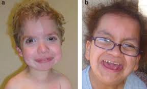 Costello syndrome: a Ras/mitogen activated protein kinase pathway syndrome  (rasopathy) resulting from HRAS germline mutations