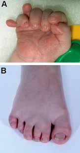 Image result for Polydactyly