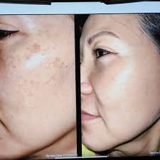 LOS GATOS DERMATOLOGY