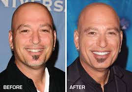 Howie Mandel Porcelain Veneer Smile Makeover