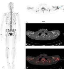 Pain in the breast is rarely the first noticeable symptom of breast cancer. A 42 Year Old Female With Right Sided Breast Cancer And Severe Left Download Scientific Diagram