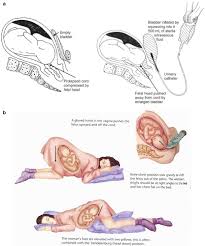Cord Prolapse And Transverse Lie Springerlink