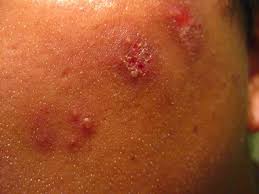 Condition info, how shingles feels, signs and symptoms Everything You Need To Know About Shingles And How To Avoid It