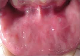 Image result for Pathergy