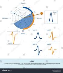 Image result for Left Axis Deviation