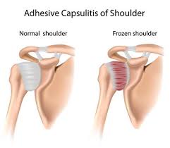 Image result for Frozen Shoulder