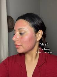 Micro Needling Before and After Acne Scars