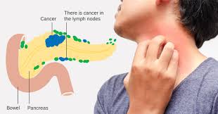 Intermittent, and occasionally severe, abdominal. 10 Warning Signs Of Pancreatic Cancer You Need To Know David Avocado Wolfe