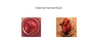 Image result for Hemorrhoid