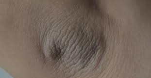 Check spelling or type a new query. Acanthosis Nigricans Causes Symptoms Treatment And Pictures