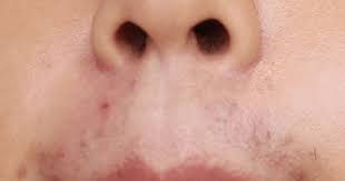 Other potential side effects are swelling, redness, and scarring. Sliq Clinic Alma Laser Hair Removal Review Fishmeatdie