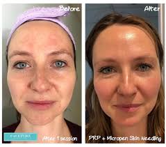 Skins that are of uneven texture tend to be dull, dry, and rough. Facetime Skin Body Clinic Check This Out After Just 1 Session Of Prp Platelet Rich Plasma Therapy With Micropen Skin Needling Microneedling With Prp Platelet Rich Plasma Also Known