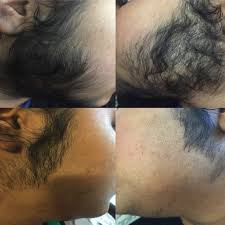 Tips are part of the technicians bread and butter. Hair Reduction In A Patient After 2 Sessions Of Nd Yag Laser Hair Removal Download Scientific Diagram