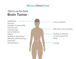 Many people experience an aura before having a seizure. Early Symptoms Of A Brain Tumor Mental And Physical Signs