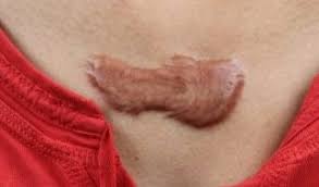 In order to increase the success rate of keloid removal, an individualized treatment plan is necessary. Keloid Hypertrophic Scarring