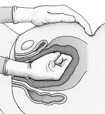 Image result for Uterine Inversion