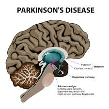 A parkinson's off episode treatment option that may relieve your symptoms. Parkinsons Disease German Neuroscience Center Dubai