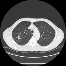 If the condition is misdiagnosed or its symptoms are ignored, a patient may not receive appropriate treatment until the cancer has progressed to an advanced stage. Tuberculosis Mimicking Lung Cancer Sciencedirect