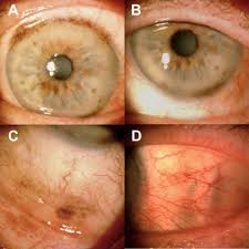 Image result for conjunctival melanoma