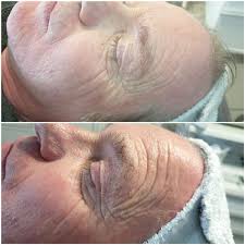 We did not find results for: Hifu Ultraschall Lifting Beauty Bonn Pureline Elke Munzer