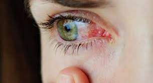 Common Eye Infections Australian Prescriber