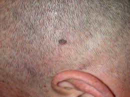 The good news is that when identified and treated early, most nonmelanoma skin cancers are curable. Skin Cancer On Scalp Prevention Tips For Bald Men Scary Symptoms