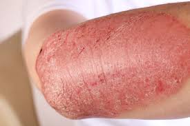 Image result for skin rash acute hiv infection