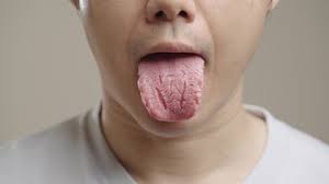 Image result for Fissured tongue