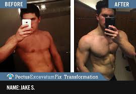 We did not find results for: Pectus Excavatum Bodybuilding Transformation Workout Programs Bodybuilding Transformation Workout Plan