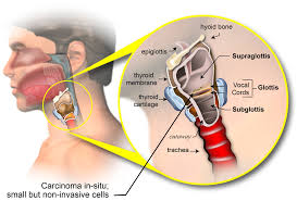 Know the signs and symptoms of laryngeal and hypopharyngeal cancer to understand more about early throat cancer, how it's tested for, diagnosed, and staged. What Are The Symptoms Of Cancer Of The Larynx
