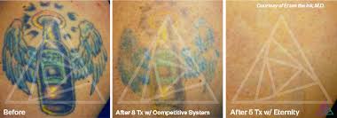 So it's no surprise that. Tattoo Removal Before After Photos Tattoo Removal Patient Results