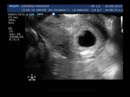 Esto es debido a un tránsito más lento en el intestino por el efecto hormonal secundario al embarazo y, a medida que pasan las semanas de gestación,. Ecografia 6 Semanas De Embarazo 1er Eco Youtube