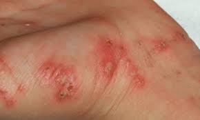 Image result for scabies human bites