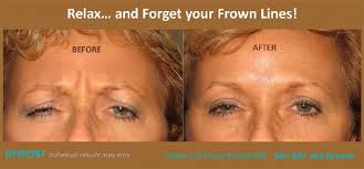 How to get rid of lines between eyebrows. Frown Lines Plano Tx Wrinkle Reduction Frisco Tx