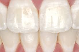 We all know that green tea is healthy, but it can also supply essential vitamins as well as minerals necessary to mineralize the teeth. Repair White Spots White Marks On Teeth With Remineralising Toothpaste