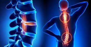 Image result for Spinal Trauma