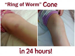 Worm Of Ring Protocol Safe Effective Natural And Fast Sweet T Makes Thre Essential Oils For Ringworm Home Remedies For Ringworm Essential Oils Ringworm