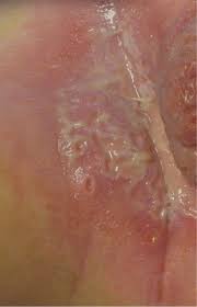Rashes are extremely common in newborns and can be a significant source of parental concern. Infant With Diaper Rash And White Bumps Photo Quiz American Family Physician