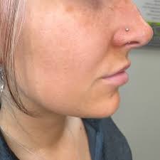 “Keyhole lips” refer to a lip shape where there is a small, natural gap or  opening between the lips, often in the center, even when they are slightly  closed. This look can be natural or enhanced with ...