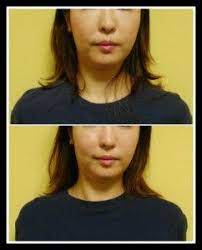 顔が長い ぼやけた顔の女性 面長矯正でなおった写真 顎 顎 短く フォトフェイシャル