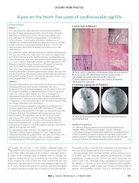 Image result for Cardiovascular Syphilis