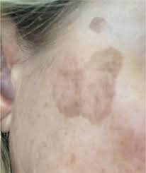 Solar purpura affects the inner layer of the skin known as the dermis. Pigmentation Disorders In The Elderly Springerlink