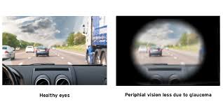 The symptoms can start so slowly that you may not notice them. Glaucoma Aoa