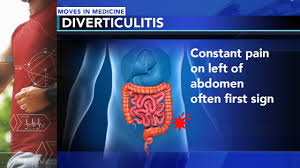 Image result for Diverticulitis