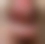 Image result for syphilis ulcer