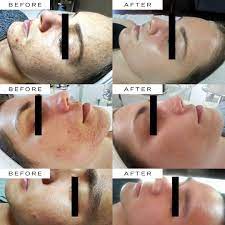 We Asked A Micro Needling Expert All Our Burning Questions Microneedling Skin Needling Beauty Skin Care Routine