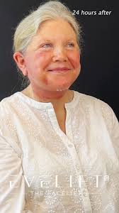 ✨ Just one day to see amazing results! ✨, Meet Alison, 75-year-young, who  traveled all the way from Georgia for our exclusive EVELift®. In less than  24 hours, we enhanced her jawline, defined her ...