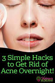 How To Get Rid Of Acne Overnight Skin Tight Naturals Acne Overnight How To Get Rid Of Acne Forehead Acne
