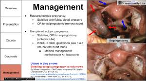 Ruptured ectopic pregnancy symptoms and signs include the feeling of faint, dizziness or fainting body weakness from blood loss Ectopic Pregnancy Youtube